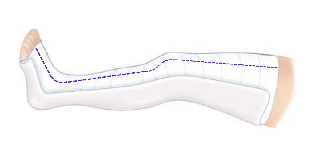 Bivalving a cast to relieve compartment pressure
